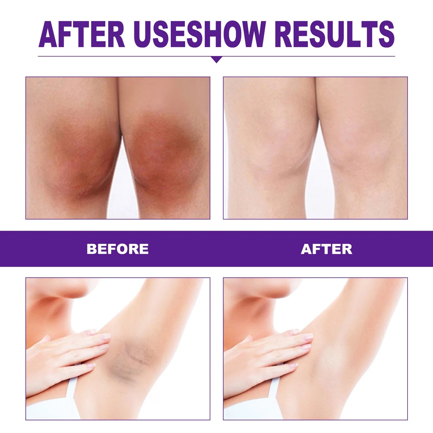 Body Whitening Cream Brightening Intimate Area Underarm Butt Inner Thigh Bleaching Remove Melanin Private Parts Whitening Cream