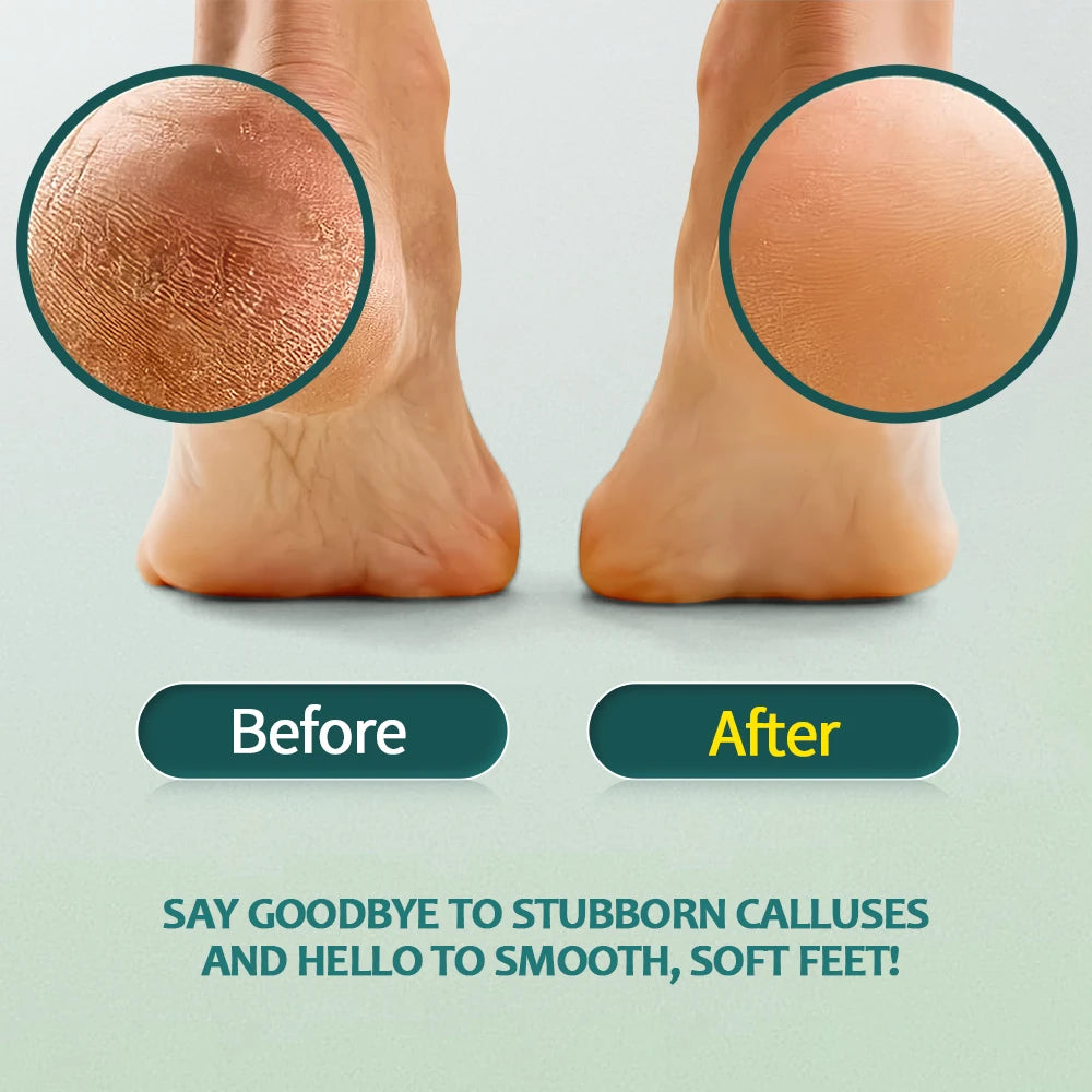 NAILPOP Extra Strength Callus Remover for Feet and Foot File Kit Remove Hard Skins Heels and Tough Callouses from feet Quickly